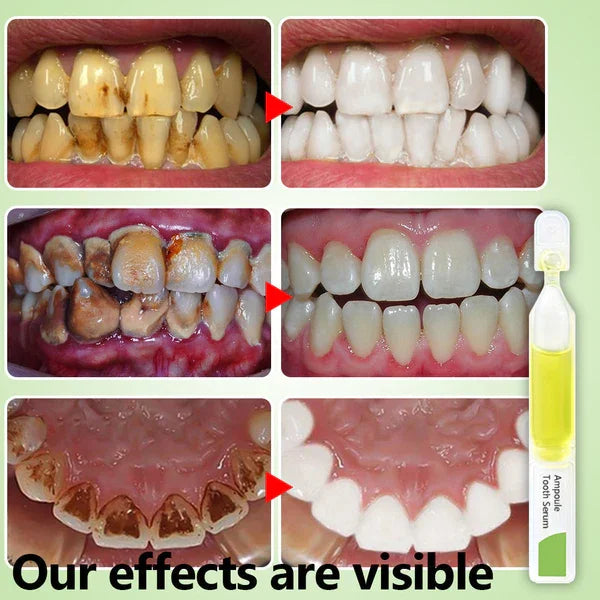 SmileMate™ Removal of tartar and plaque bacteria and various oral problems