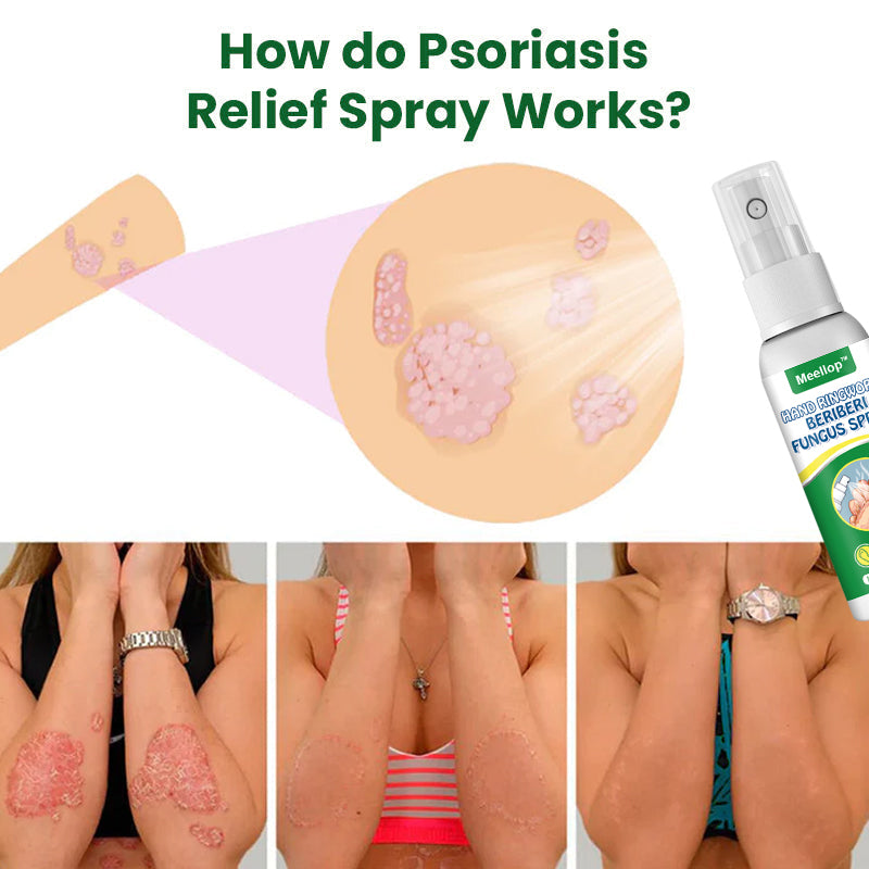Meellop™ Herbal Psoriasis Relief Spray