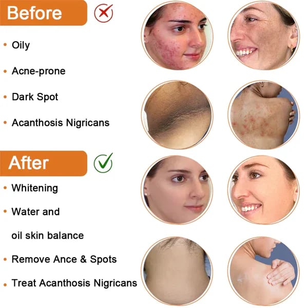Fivfivgo™ Cleansing Lotion for Acne & Spots & Acanthosis Nigricans