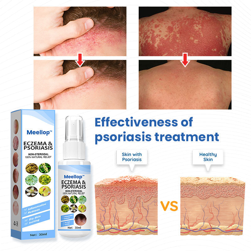 Meellop™ Psoriasis Treatment Spray💖