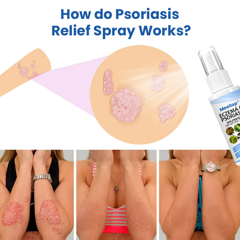 Meellop™ Psoriasis Treatment Spray💖